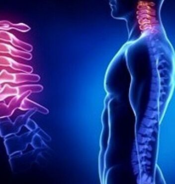 L'ostéochondrose cervicale peut être causée par des blessures au cou
