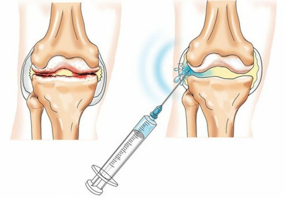 Injection dans l'articulation du genou pour l'arthrose
