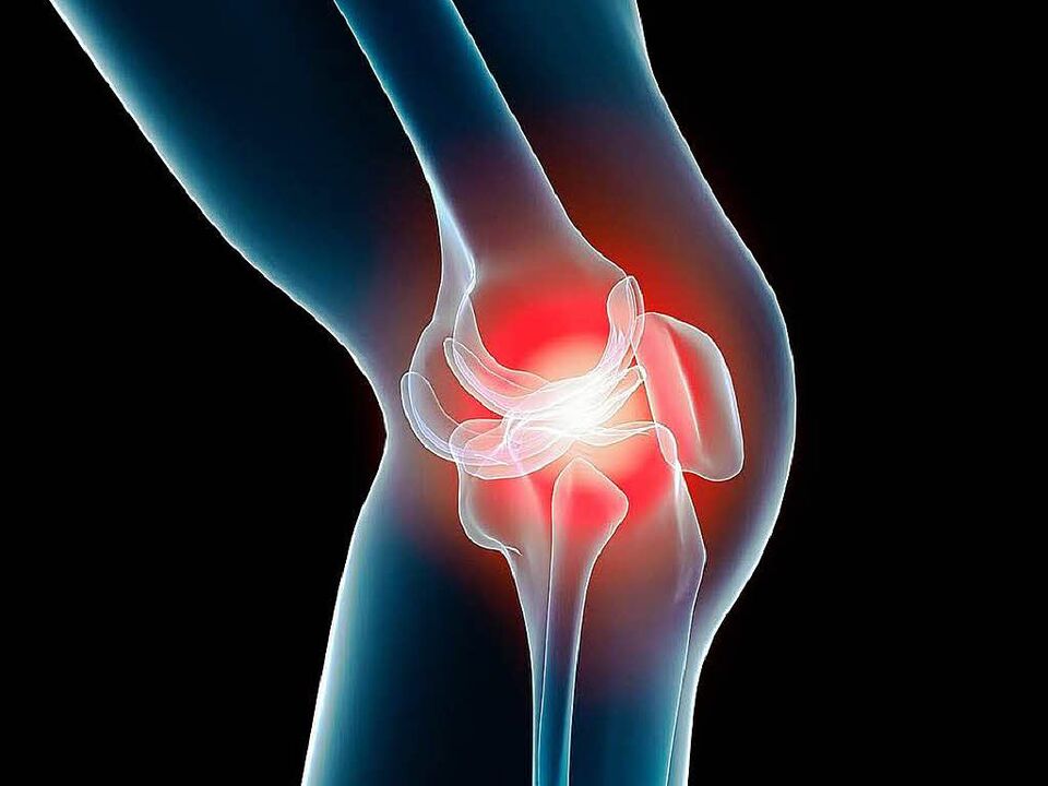 arthrose du genou